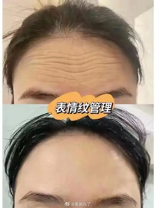 我是一个面部表情比较丰富的人,所以我觉得我的鱼尾纹和抬头纹比同龄