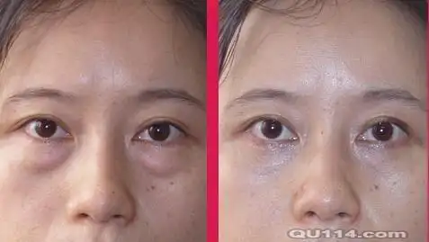 去眼袋手术后六天照片