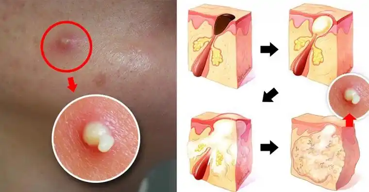 痘痘肌要不要化妆