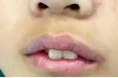 凸嘴龅牙萧山7岁男孩越长越丑父母3年后才明白错在哪