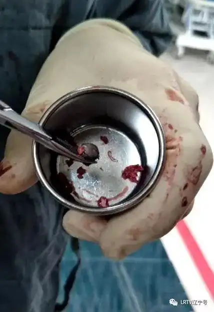 打开,医生才取出了颅内的铅弹和骨头碎片,幸运的是子弹没有伤到脑组织