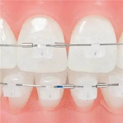 陶瓷自锁托槽矫正器