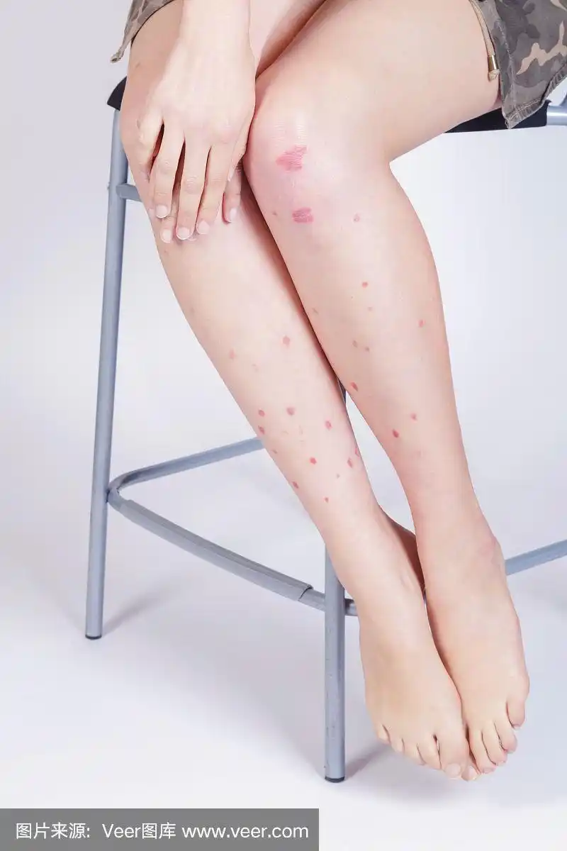 一个腿上有牛皮癣的年轻女人.