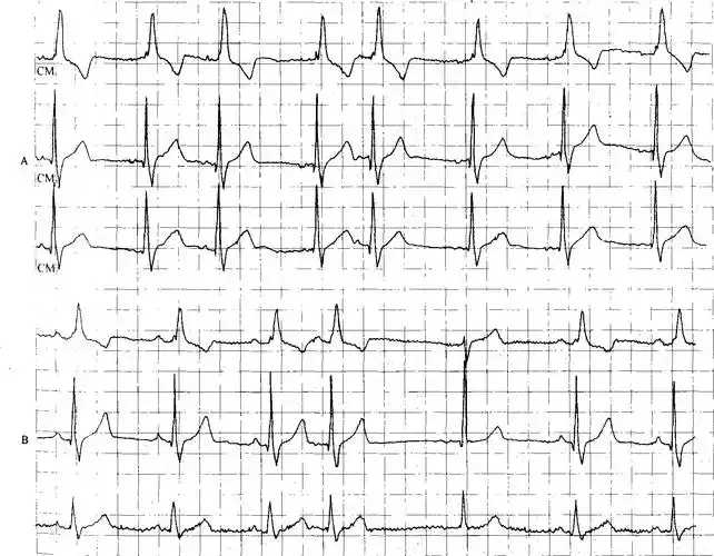 8-10 加速的房性逸搏伴房性早搏-精编心电图诊断-医学