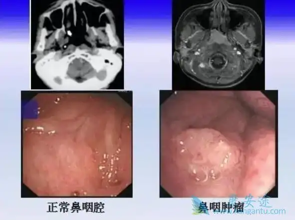 鼻咽癌症状中这两种症状患者需警惕