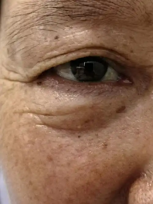 考虑脂溢性角化/老年斑.可以使用激光治疗去除.