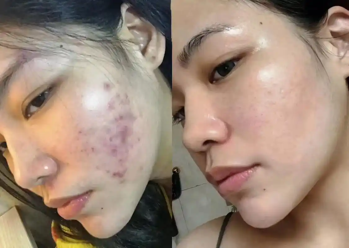 98角质层比较薄  痘痘肌  做了无针水.98角质层比较薄  - 抖音