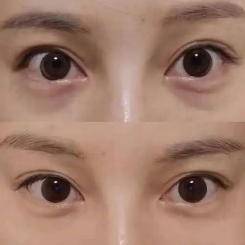 话不多说,直接给你们看对比吧,泪沟真的太影响年龄感_圈子-新氧美容