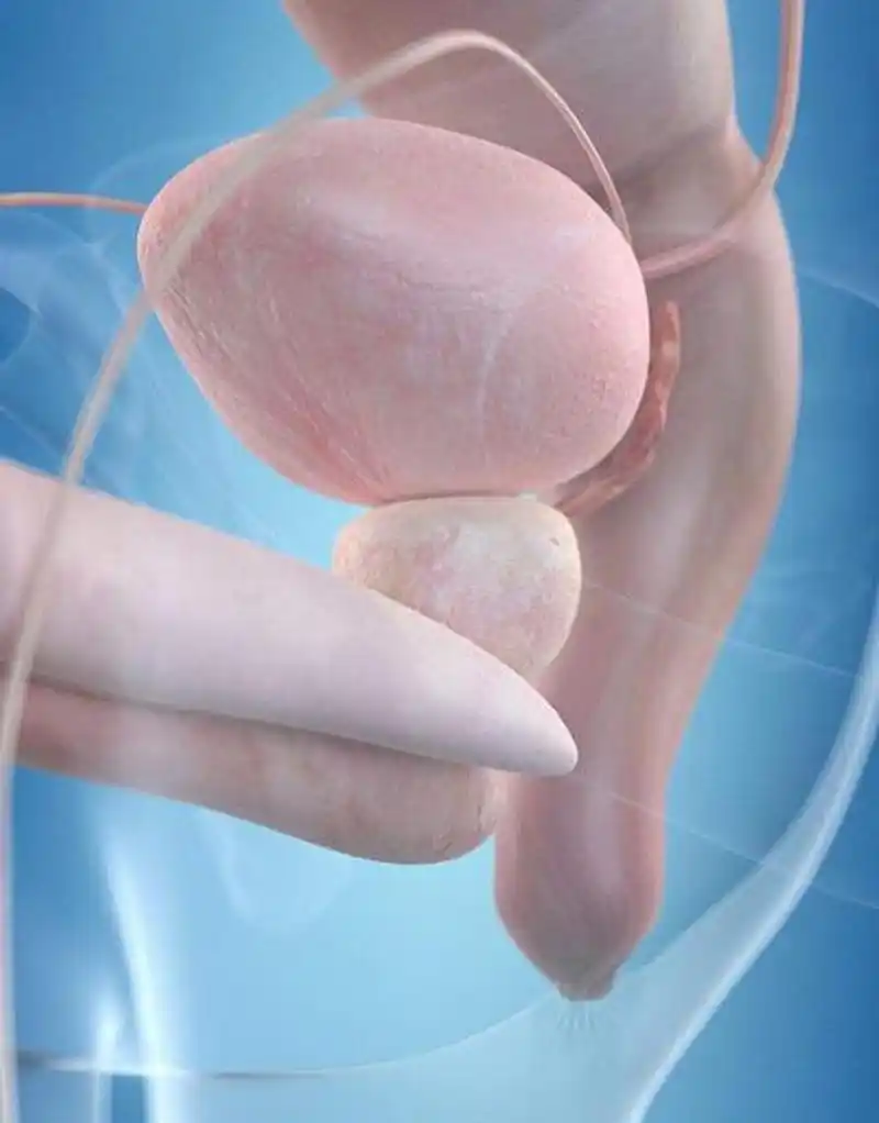 丁丁装了假体 使用时该注意什么?