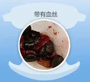 带有红色血丝,带有血或粘液的干硬大便,又名血便:鲜红色大便表明宝宝