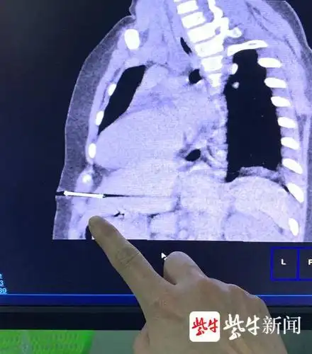 六岁女童玩射钉枪,一枪钢钉射入腹部距心脏仅2.6厘米