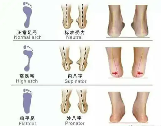 扁平足该怎么治疗!请不要不要小看它