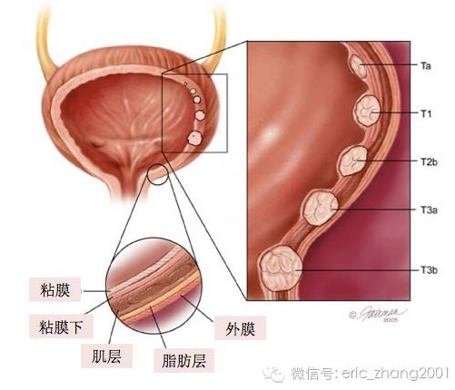 膀胱里长了东东?