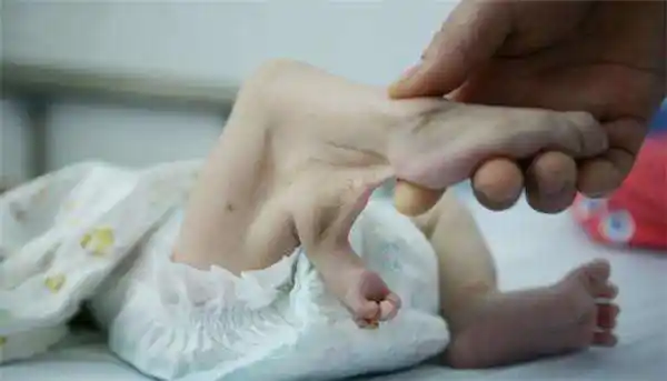 孕妇怀二胎从不产检,剖腹产生下畸形宝宝