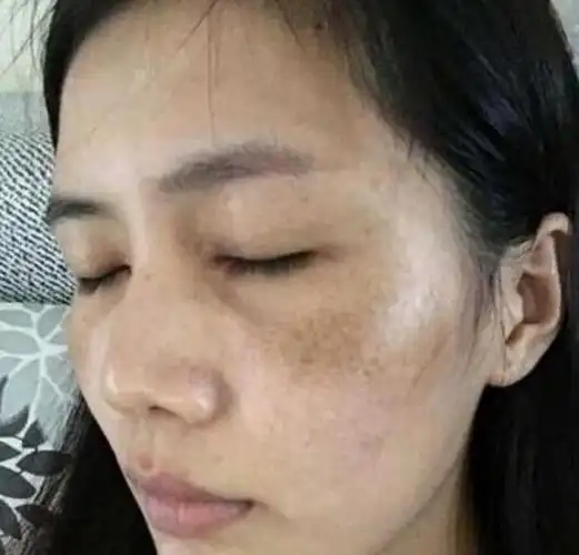 怎么去除色斑,让肌肤恢复白皙光彩(去除色斑的正确方法)-52线报网
