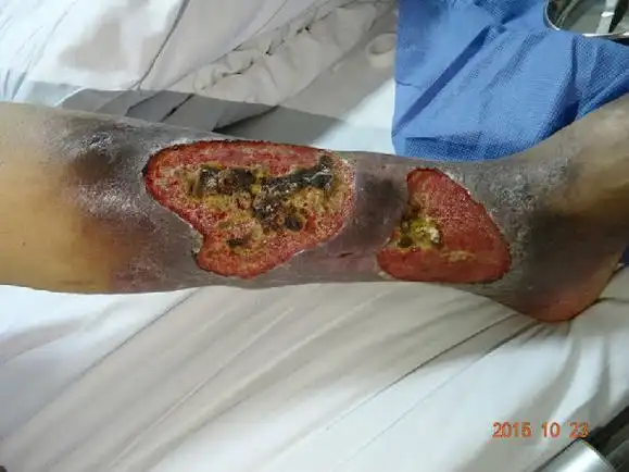 慢性骨髓炎什么时候治疗最好?