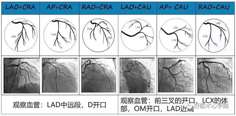 冠脉造影实用读图技巧,必备收藏贴!