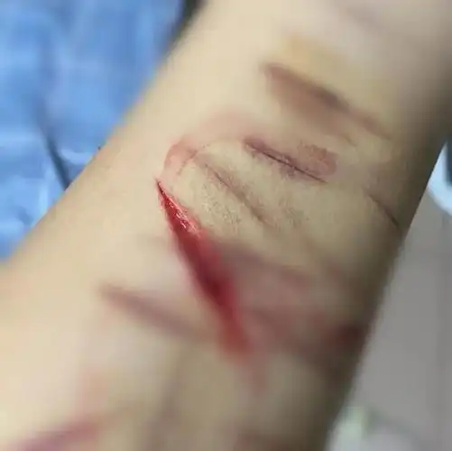 男孩失恋后割腕自杀的背后真相