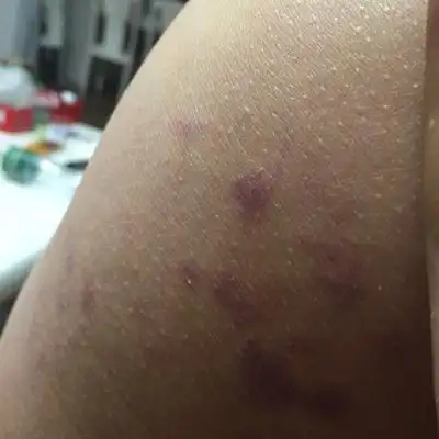 孕8月 左侧屁股上长很多紫色血点怎麼回事?有懂得吗?谢谢