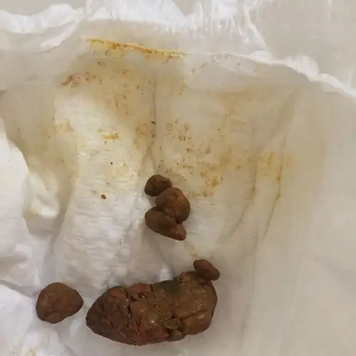 这是宝宝拉的臭臭,一坨一坨的