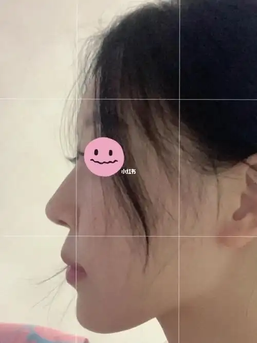 这个是鼻基底凹陷吗还是脸颊肉多肥?