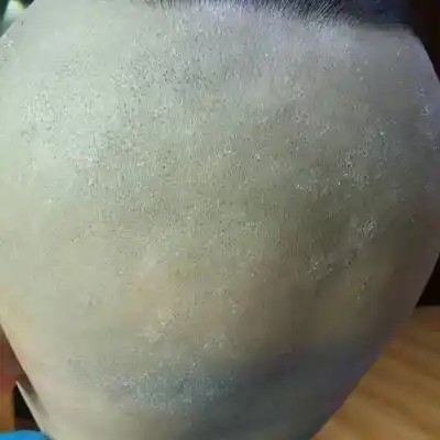 又该怎样去护理?