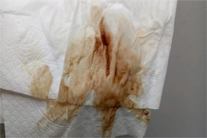 先兆流产出血图