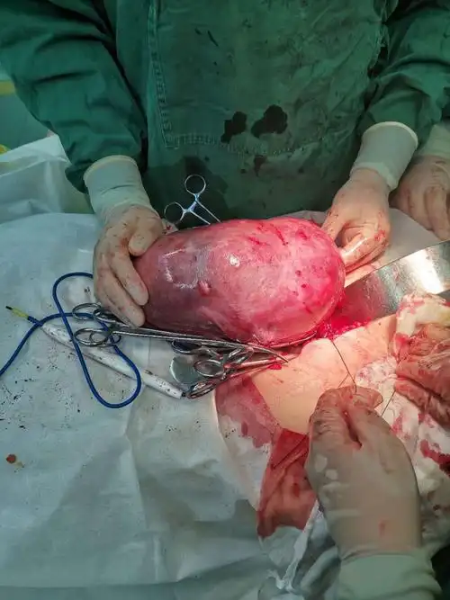 妇产二科成功完成巨大子宫切除一例