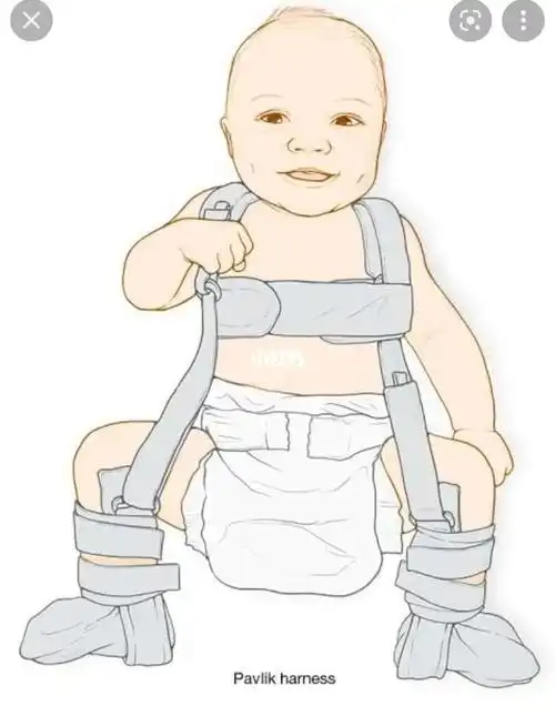 ddh髋关节发育不良