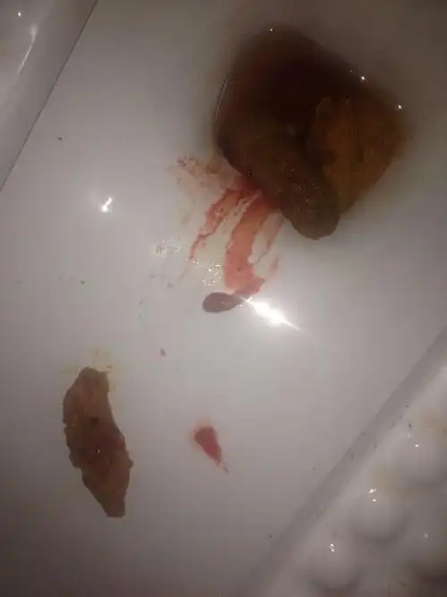 本人男十六岁爱死了上网,以前便秘出过血,鲜红色的拉的时候不痛不痒.