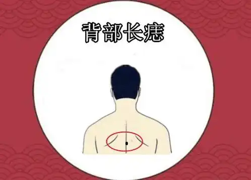 长在背部的痣有什么寓意 痣和运势的关系