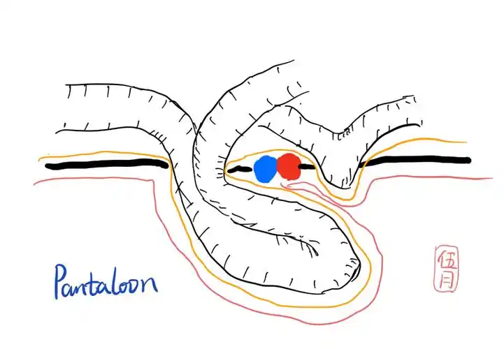 腹股沟疝只知直疝三角可不行从解剖到分类本文都帮你总结好了
