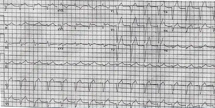 房室分离的心电图分析
