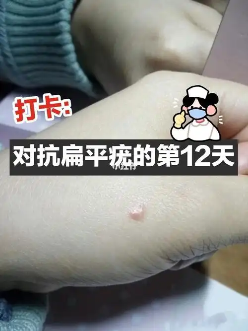 是当时不小心被人传染的我本身抵抗力就很一般,没过多久就长了扁平疣