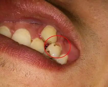 龅牙能随便拔吗