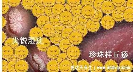 男女性尖疣湿早期症状图片,在初期出现淡红色丘疹(可呈鸡冠菜花状)