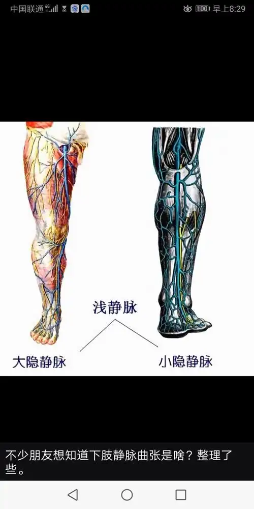 外科疾病科普篇之大隐静脉曲张 - 美篇