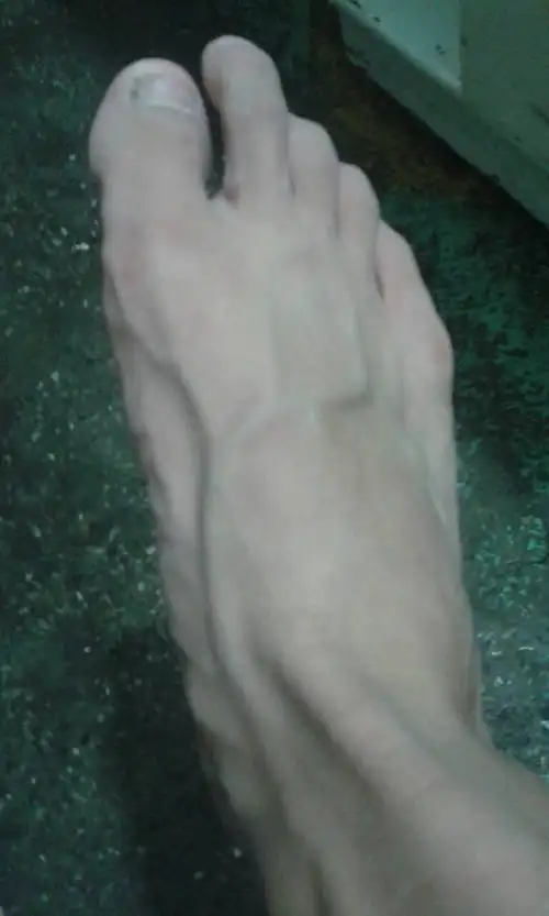 脚上血管怎么这么突出,这是怎么回事啊