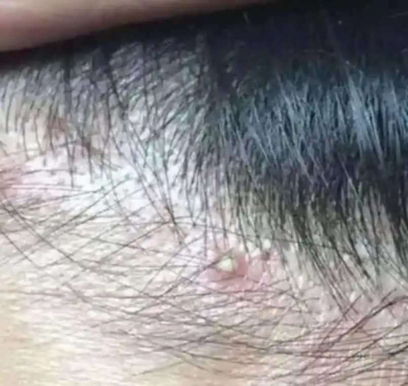 小儿头疖,多见于卫生情况差,机体免疫力较低的儿童,无传染性