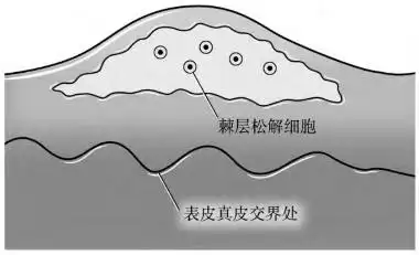 自身免疫性大疱病