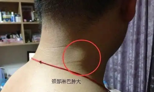 决定生死的三处淋巴结,颈部淋巴,腋下淋巴,腹股沟淋巴