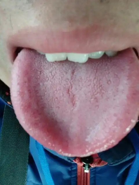 舌头两边这小疙瘩看看是什么啊?不好看到大概有三四个