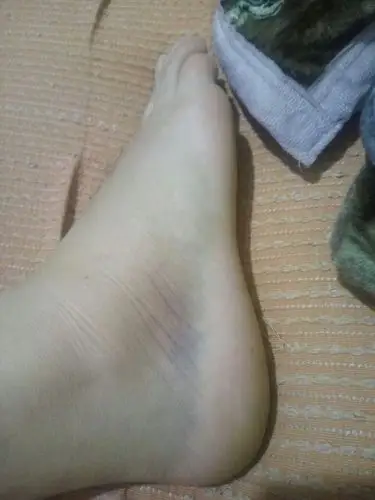 我的脚5天前不小心崴了一下,肿了第二天就不敢走了,拍片骨头没有事,不