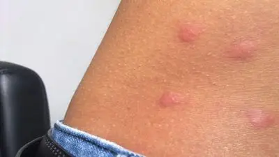 什么是皮疹? 7.7w