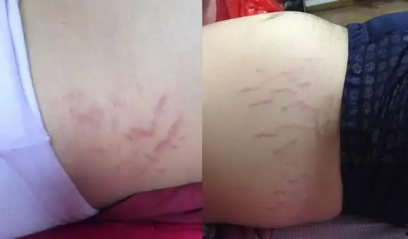 妊娠以后,当乳房和腹部膨大时,那一部分和臀部,大腿附近的皮肤,会出现