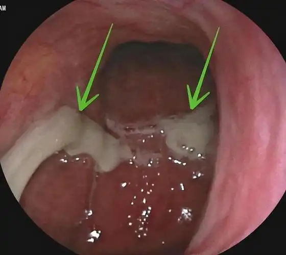 16岁高中生手写"特殊作业",还原鼻窦炎治疗前后!