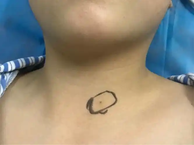 鳃裂瘘管的诊断与治疗