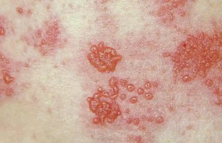 生殖器疱疹诊断主要看临床表现_生殖器疱疹_症状表现_检查 - 好大夫