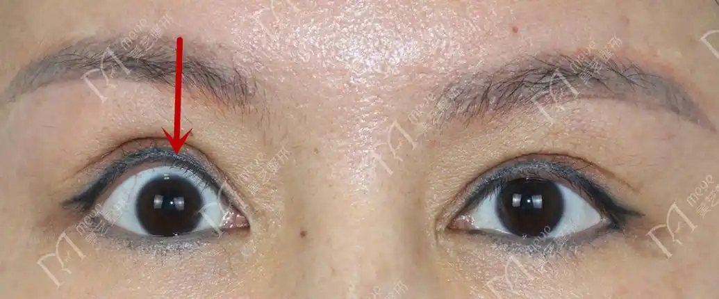 上眼睑退缩也不要忽视