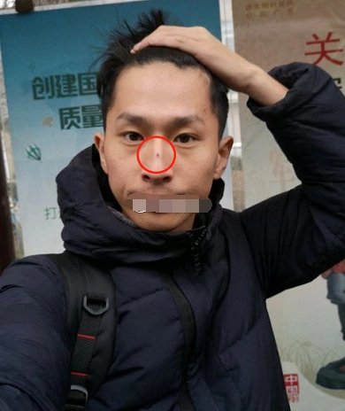 孤峰鼻鼻梁痣影响事业发展脾气大个人决断力易出问题